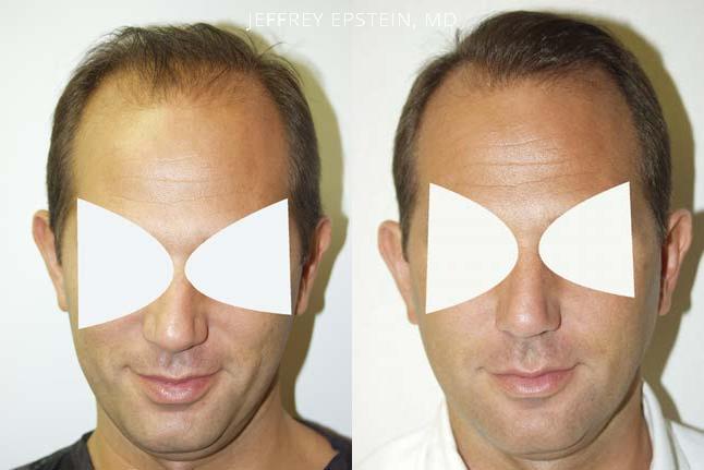 Hair Transplants for Men Before and after in Miami, FL, Paciente 38359