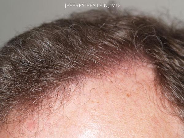 Hair Transplants for Men Before and after in Miami, FL, Paciente 38366