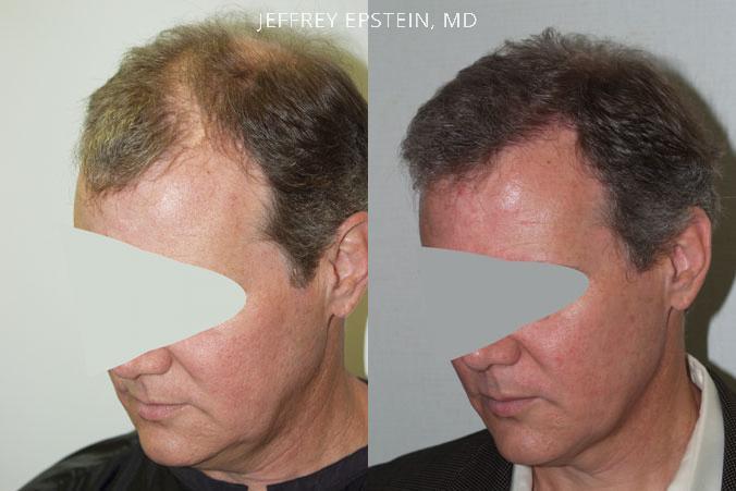 Hair Transplants for Men Before and after in Miami, FL, Paciente 38366