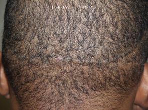 Hair Transplants for Men Before and after in Miami, FL, Paciente 38371