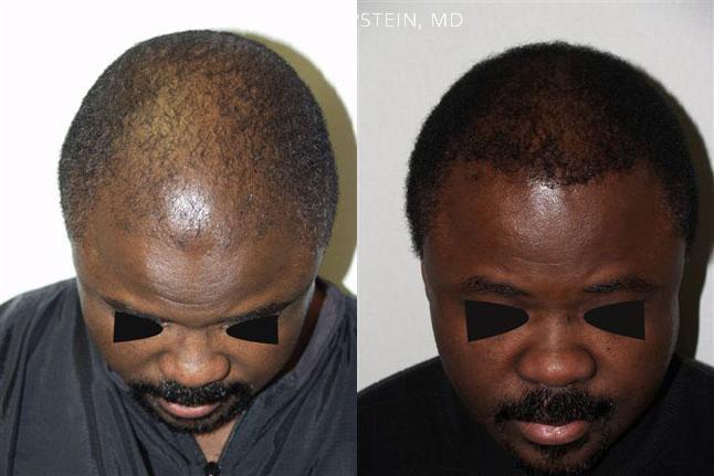 Hair Transplants for Men Before and after in Miami, FL, Paciente 38377
