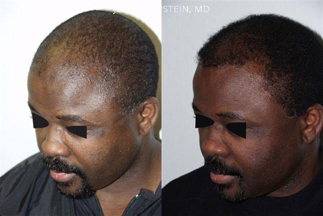 Hair Transplants for Men Before and after in Miami, FL, Paciente 38377