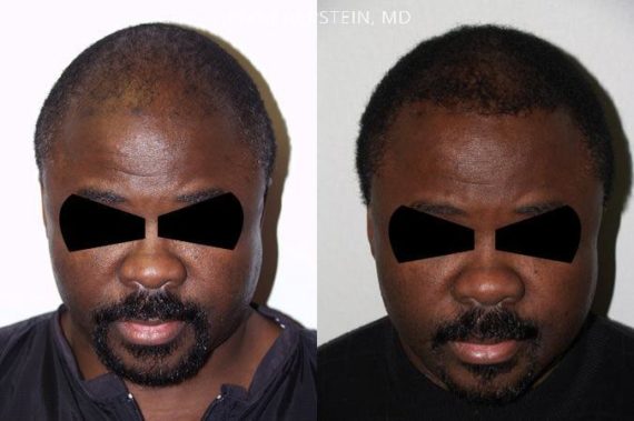 Trasplante de Pelo en Hombres Before and after in Miami, FL, Paciente 84771