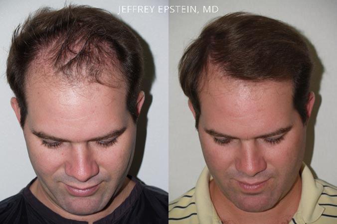 Hair Transplants for Men Before and after in Miami, FL, Paciente 38393