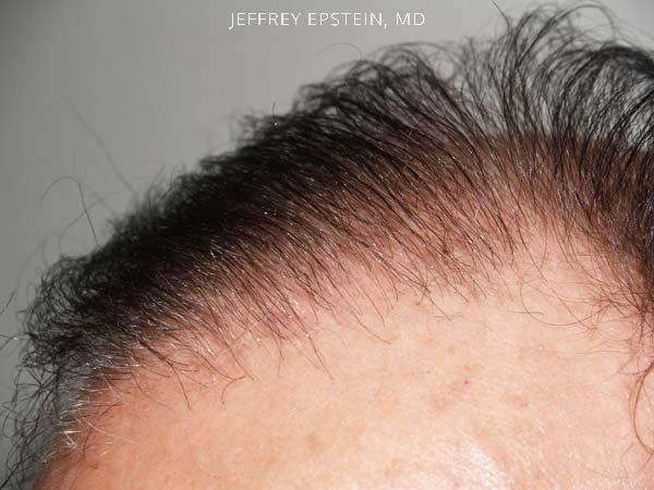 Hair Transplants for Men Before and after in Miami, FL, Paciente 38401