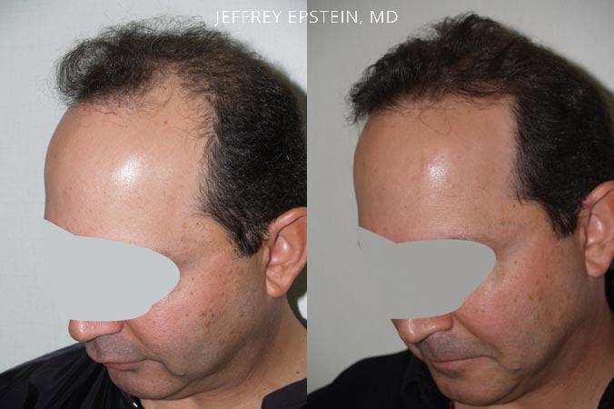 Hair Transplants for Men Before and after in Miami, FL, Paciente 38407
