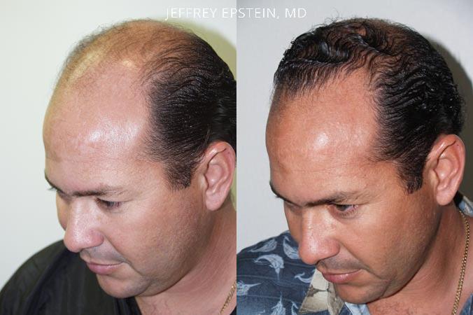 Hair Transplants for Men Before and after in Miami, FL, Paciente 38412