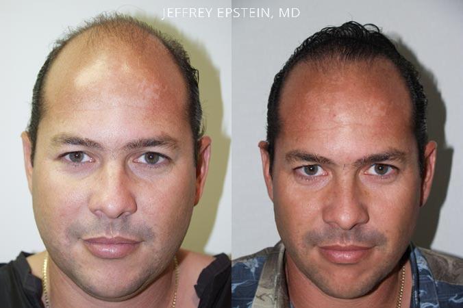 Trasplante de Pelo en Hombres Antes y después en Miami, FL, Paciente 84581