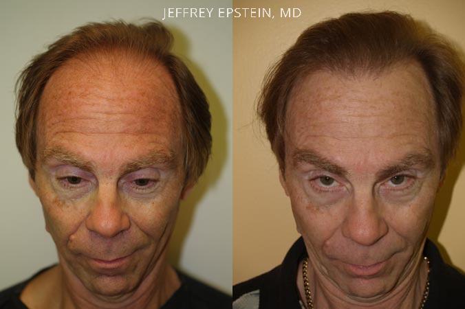 Hair Transplants for Men Before and after in Miami, FL, Paciente 38418