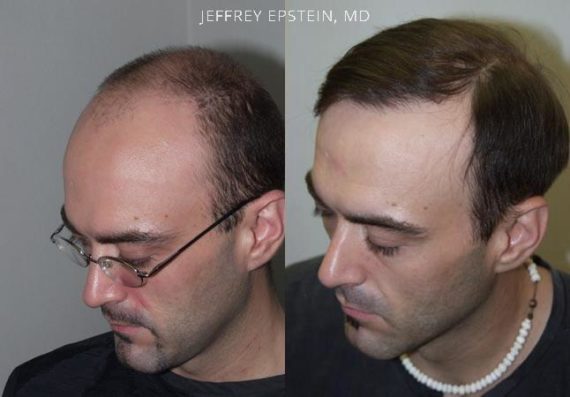 Trasplante de Pelo en Hombres Before and after in Miami, FL, Paciente 84511
