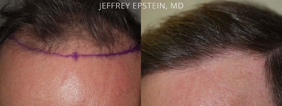 Hair Transplants for Men Before and after in Miami, FL, Paciente 38430