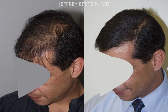 Trasplante de Pelo en Hombres Before and after in Miami, FL, Paciente 84461
