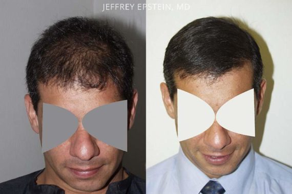 Trasplante de Pelo en Hombres Before and after in Miami, FL, Paciente 84461