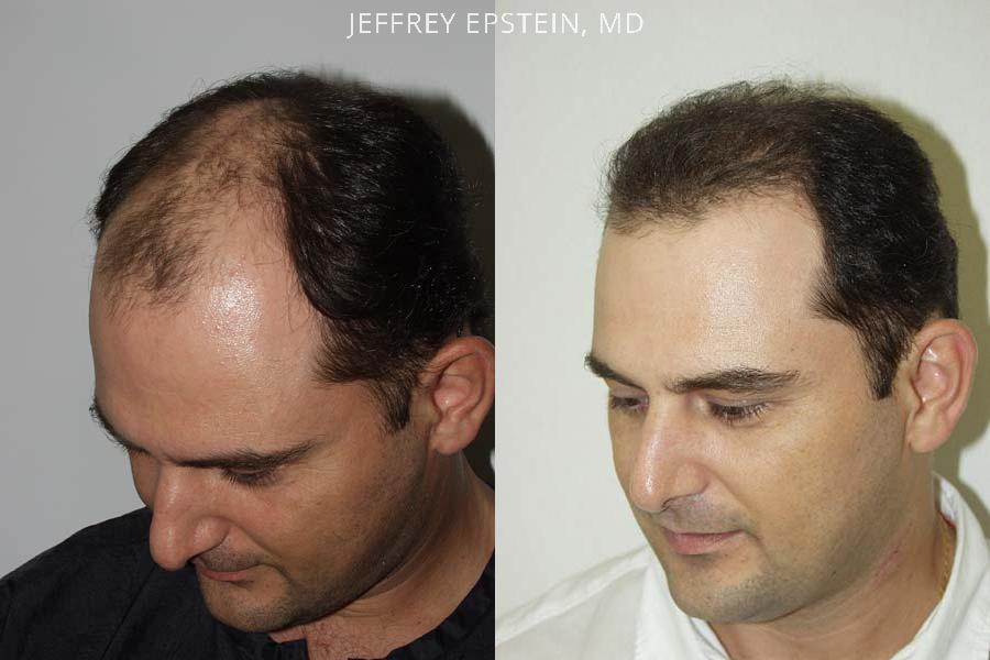 Hair Transplants for Men Before and after in Miami, FL, Paciente 38440