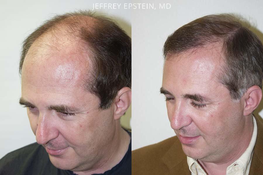 Hair Transplants for Men Before and after in Miami, FL, Paciente 38445