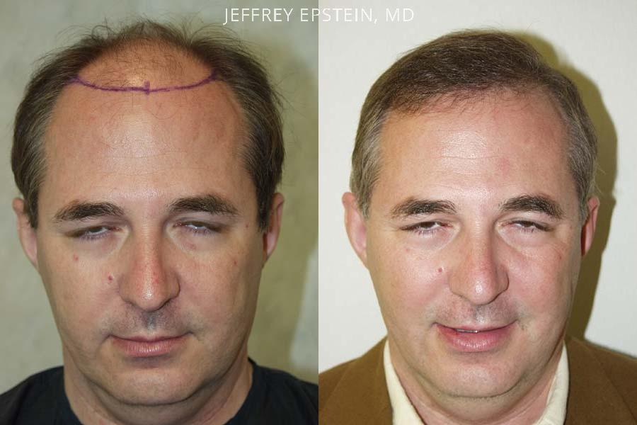 Hair Transplants for Men Before and after in Miami, FL, Paciente 38445