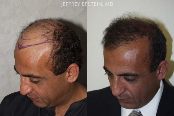 Trasplante de Pelo en Hombres Before and after in Miami, FL, Paciente 84386