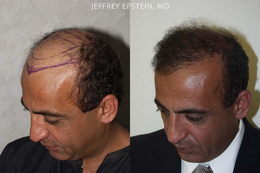Hair Transplants for Men Before and after in Miami, FL, Paciente 38451