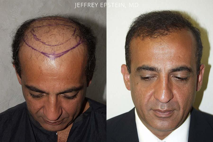 Hair Transplants for Men Before and after in Miami, FL, Paciente 38451