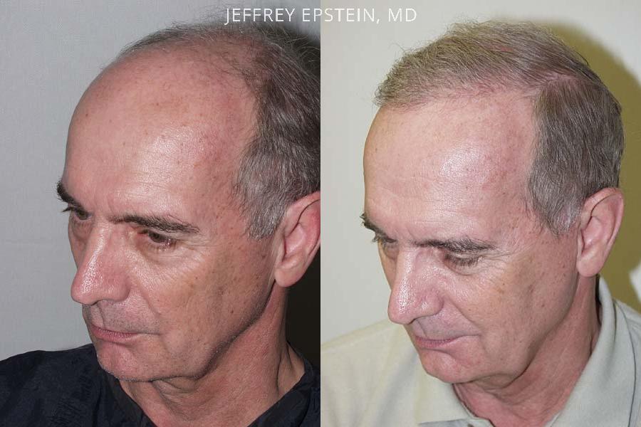 Trasplante de Pelo en Hombres Antes y después en Miami, FL, Paciente 84361