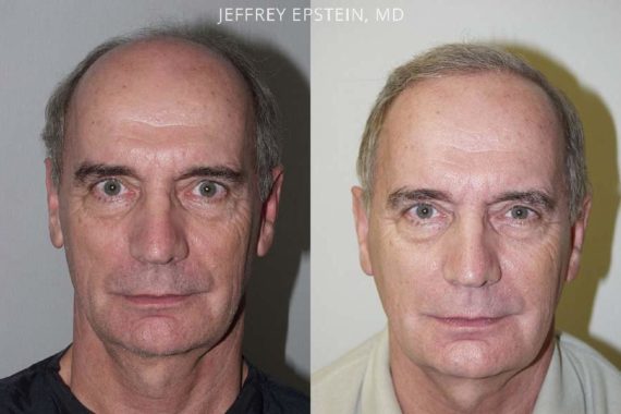 Trasplante de Pelo en Hombres Before and after in Miami, FL, Paciente 84361