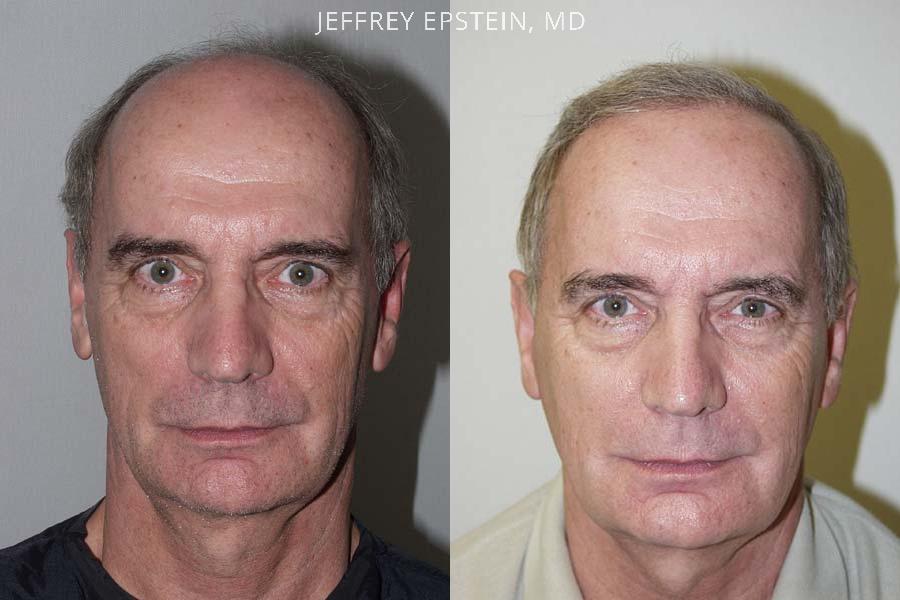 Hair Transplants for Men Before and after in Miami, FL, Paciente 38456