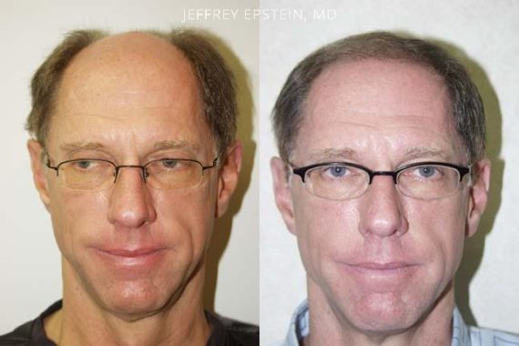 Hair Transplants for Men Before and after in Miami, FL, Paciente 38461