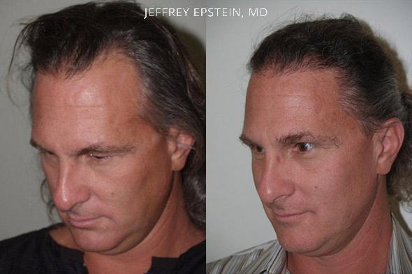 Trasplante de Pelo en Hombres Antes y después en Miami, FL, Paciente 84303