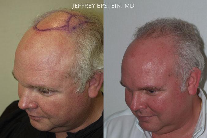Hair Transplants for Men Before and after in Miami, FL, Paciente 38471