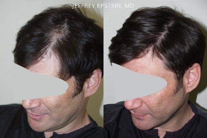 Hair Transplants for Men Before and after in Miami, FL, Paciente 38476