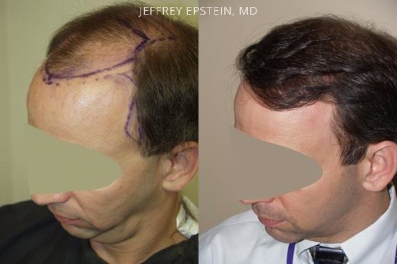 Trasplante de Pelo en Hombres Before and after in Miami, FL, Paciente 84230
