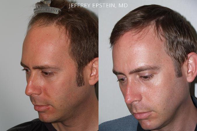 Hair Transplants for Men Before and after in Miami, FL, Paciente 38485