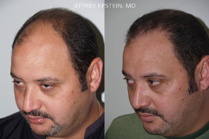 Hair Transplants for Men Before and after in Miami, FL, Paciente 38490