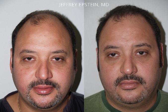 Hair Transplants for Men Before and after in Miami, FL, Paciente 38490