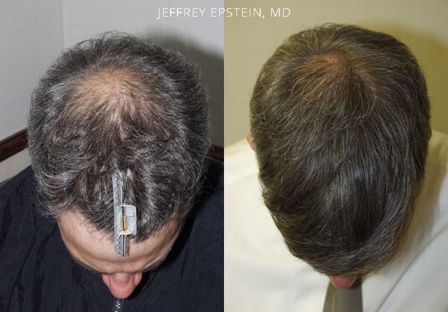 Hair Transplants for Men Before and after in Miami, FL, Paciente 38501