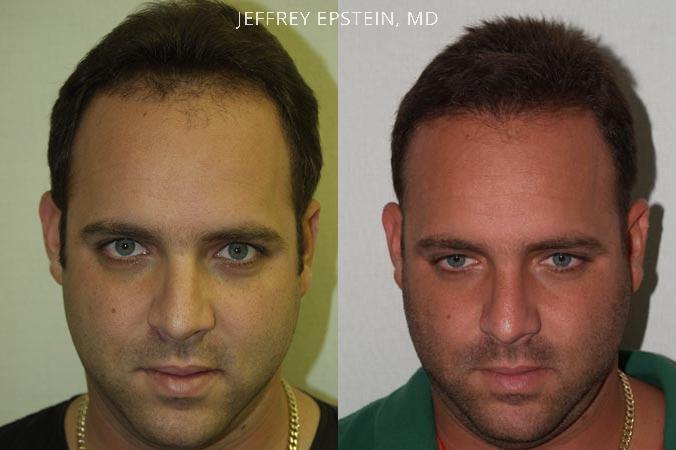 Trasplante de Pelo en Hombres Antes y después en Miami, FL, Paciente 84089