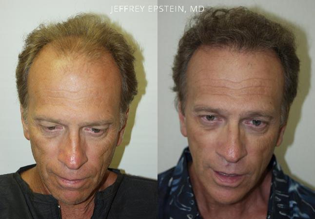 Hair Transplants for Men Before and after in Miami, FL, Paciente 38510