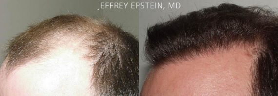 Trasplante de Pelo en Hombres Before and after in Miami, FL, Paciente 84010