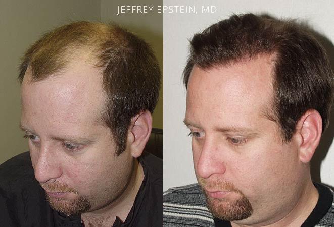 Hair Transplants for Men Before and after in Miami, FL, Paciente 38516