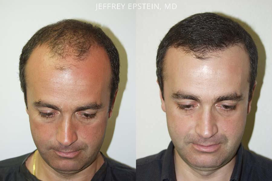 Hair Transplants for Men Before and after in Miami, FL, Paciente 38524