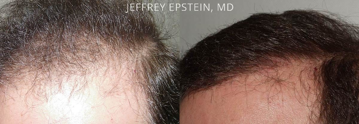 Hair Transplants for Men Before and after in Miami, FL, Paciente 38529