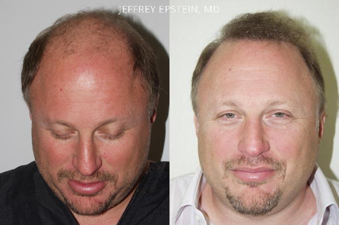 Hair Transplants for Men Before and after in Miami, FL, Paciente 38534