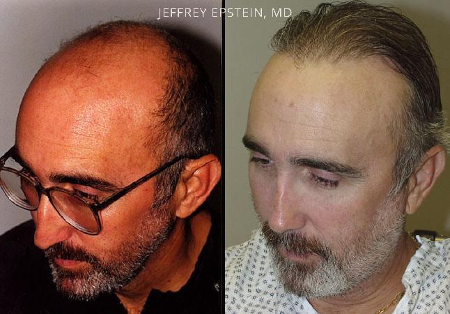 Hair Transplants for Men Before and after in Miami, FL, Paciente 38539