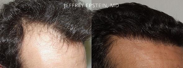 Hair Transplants for Men Before and after in Miami, FL, Paciente 38542