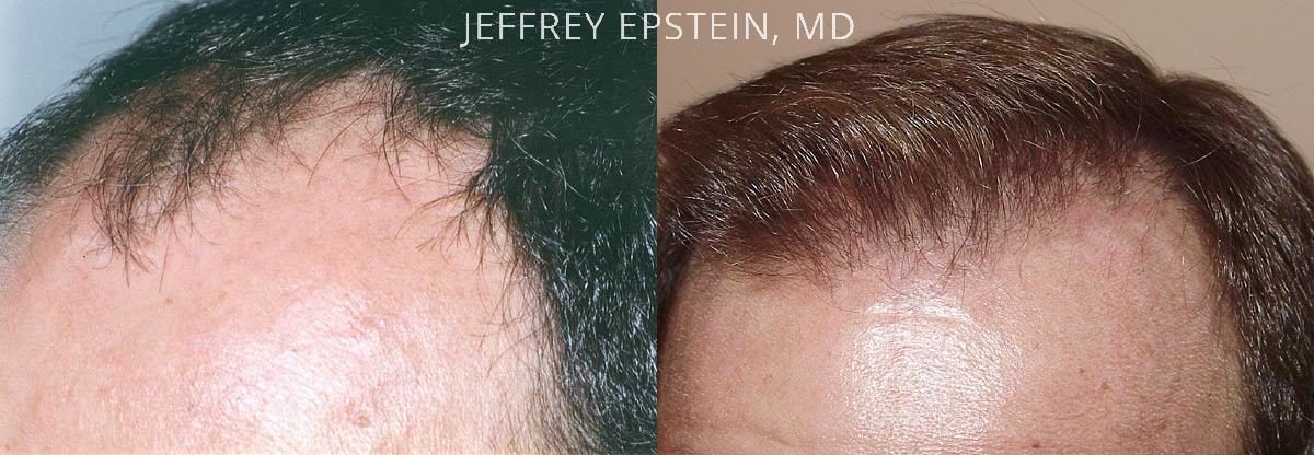 Hair Transplants for Men Before and after in Miami, FL, Paciente 38547
