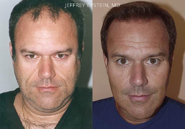 Hair Transplants for Men Before and after in Miami, FL, Paciente 38547