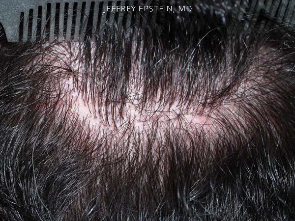 Hair Transplants for Men Before and after in Miami, FL, Paciente 38558