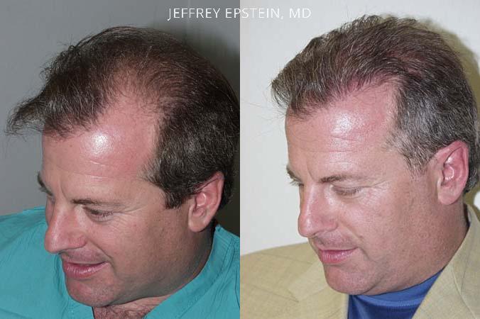 Hair Transplants for Men Before and after in Miami, FL, Paciente 38562