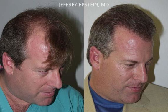 Trasplante de Pelo en Hombres Before and after in Miami, FL, Paciente 83740