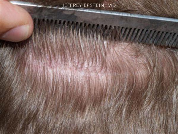 Hair Transplants for Men Before and after in Miami, FL, Paciente 38567
